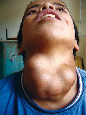 what-is-goiter